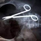 Tizennyolc év után operáltak ki egy ollót egy vietnami férfi hasából